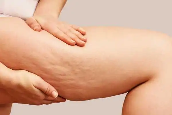 Image of woman showing leg with cellulite Selly Oak
