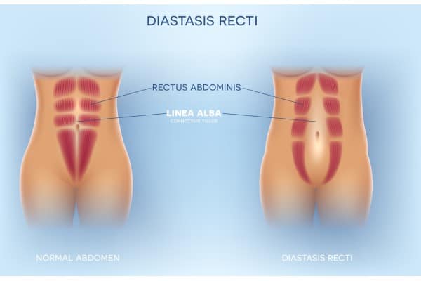 What Non-Surgical Options Are Available for Diastasis Recti Selly Oak?