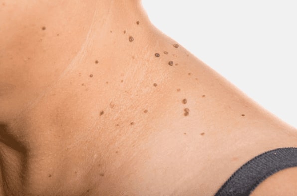 Are you looking for easy skin tag removal Selly Oak - then contact Spire today!