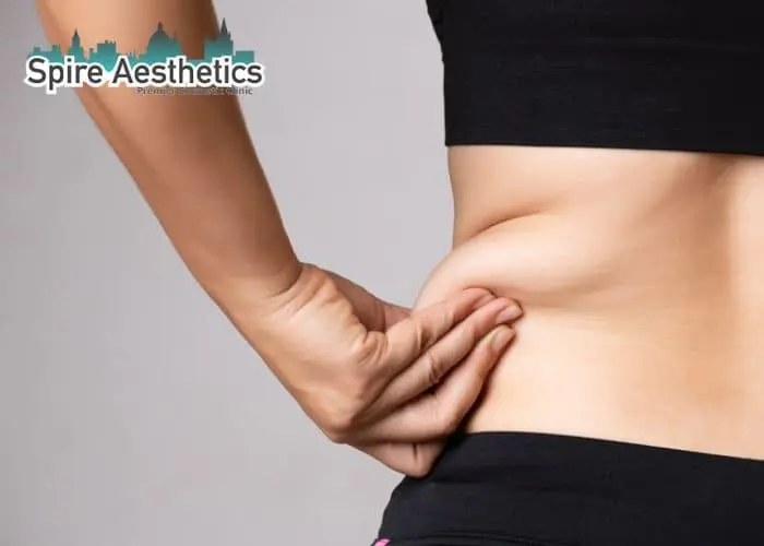 Image of woman pinching fat on their hips Selly Oak. Fat Freezing treatment