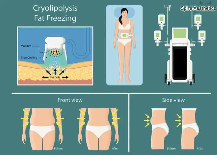 Fat freezing treatment Selly Oak benefits for competitions to remove stubborn fat deposits.
