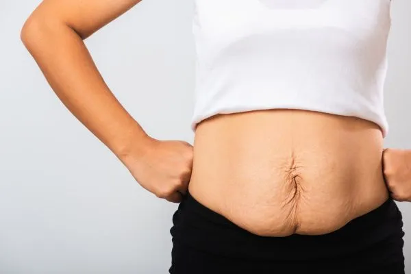 Image of a woman's stomach after weight loss with sagging skin following a gastric band Selly Oak