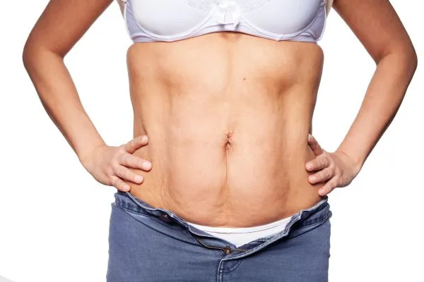 sagging skin on woman's stomach after weight loss injections Selly Oak