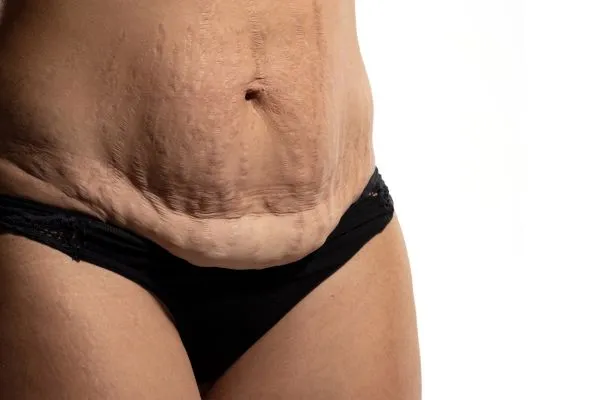 Image of womans stomach after weight loss injections Selly Oak showing saggy skin